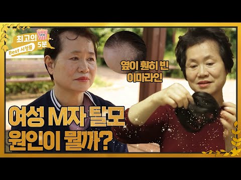 [최고의 5분_내 몸을 바꾸는 시간] 여성 M자 탈모, 원인이 뭘까? MBN 220612 방송