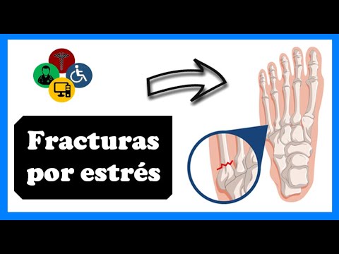 😩 FRACTURAS por ESTRES | Fractura por stress - Síntomas, causas, tratamiento