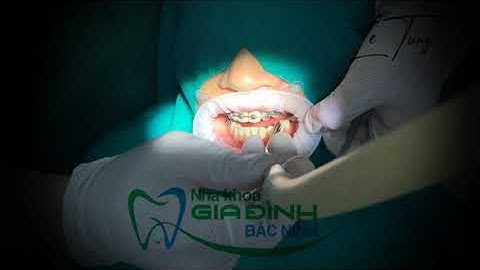 Cận Cảnh Quy Trình Gắn Mắc Cài Niềng Răng Chuẩn Hóa - NHA KHOA GIA ĐÌNH BẮC NINH