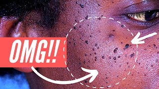 Why am I getting so many moles on my FACE?? Dermatosis Papulosa Nigra explained