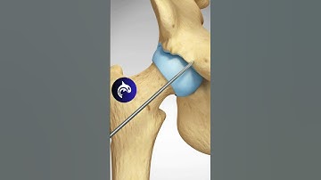 See how a Pincer Impingement of the Hip is repaired - 3D Animation