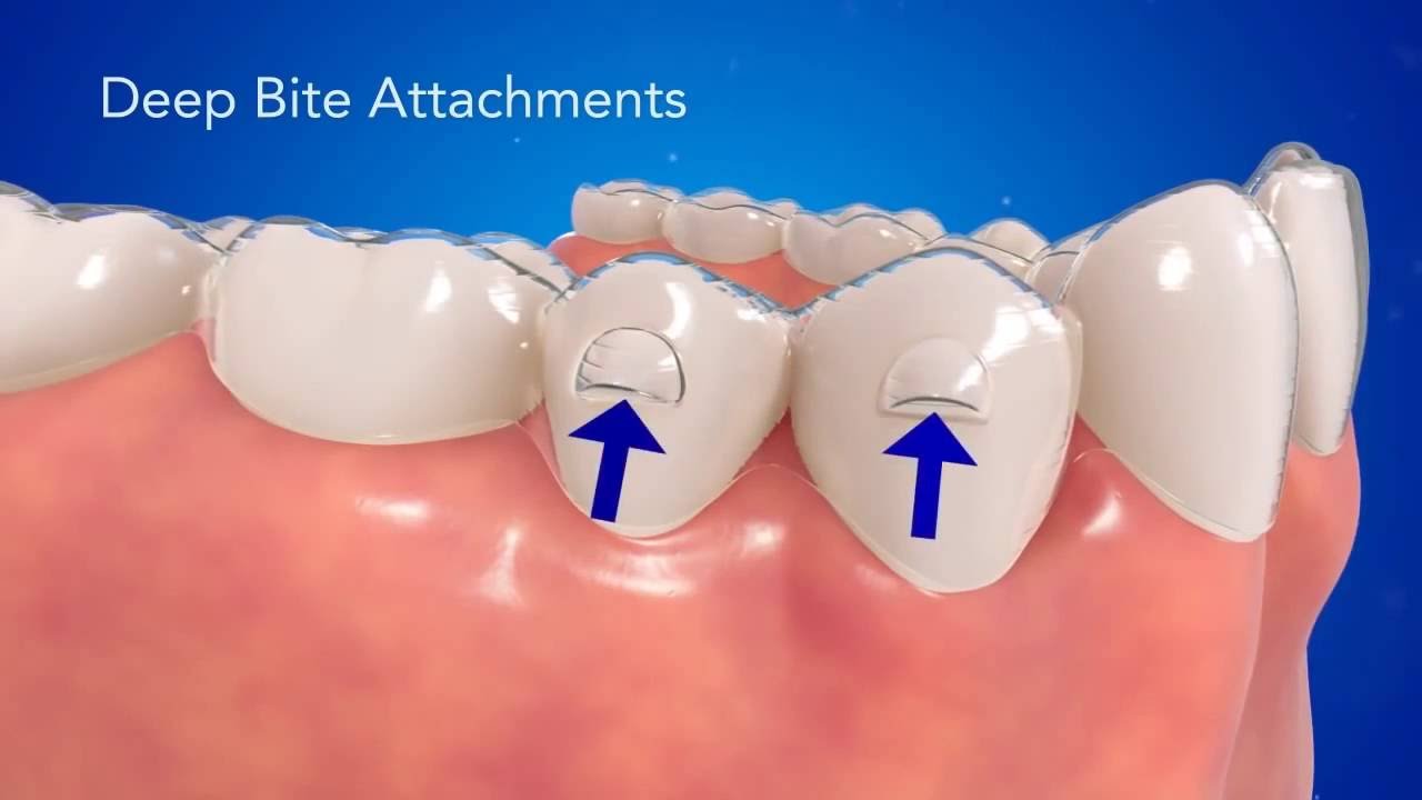INVISALIGN EXPECTATION vs. REALITY - YouTube