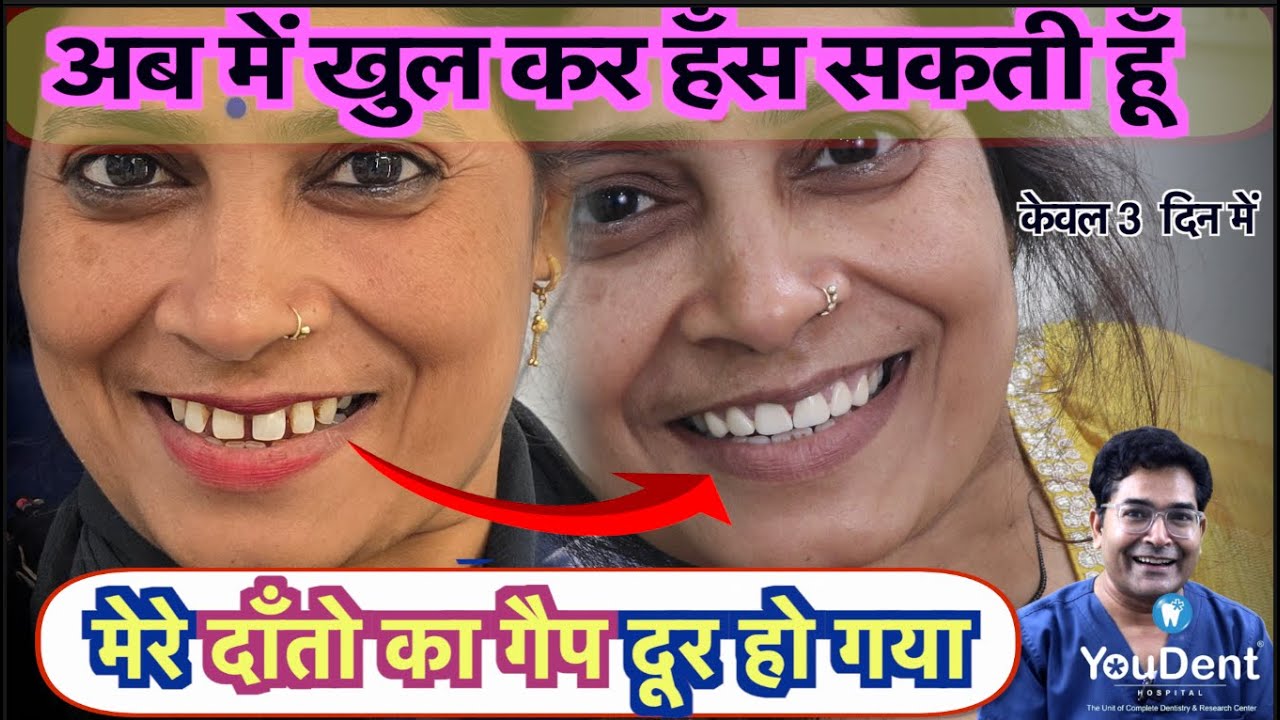 दाँतो के बीच गैप कैसे ठीक हो? | Best Dentist in India | Smile Makeover Treatment in India | YouDENT