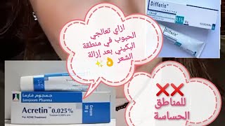 علاج حبوب البكيني بعد إزالة الشعر. كريمات التقشير لتفتيح المناطق الحساسة ❌چينا_ابراهيم beauty 4k