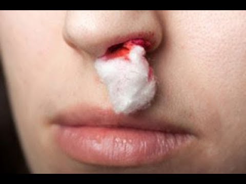 ★ Как правильно остановить кровотечение из носа. НЕЛЬЗЯ запрокидывать голову.