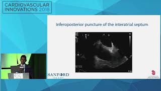 A Successful Complex Percutaneous Coronary Intervention - Maheedhar Gedela, MD
