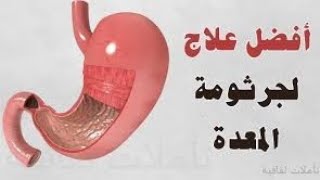 بكوبايه واحده بس هنقضى على الميكروب الحلزونى  كوب واحد بس هنتخلص من جرثومة المعدة