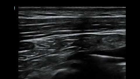 Ultrasound Case Syncope in PE  Simulus 3  Long Axis Guidewire  JETem 2025