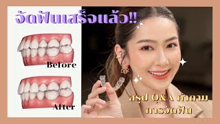 อัพเดท จัดฟันเสร็จแล้วจ้าา!! #จัดฟันแบบใส #จัดฟันinvisalign