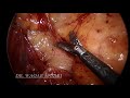 Laparoscopic inguinal hernia repair  tapp