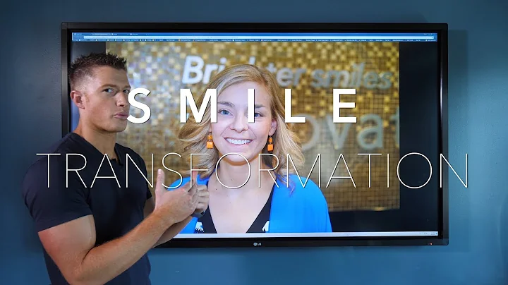 Smile Transformation - Nicole - 20 Veneers