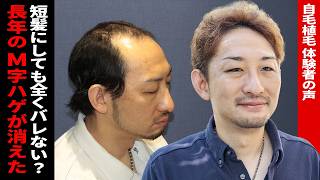 Hair Transplant][Hair Loss Treatment] - YouTube