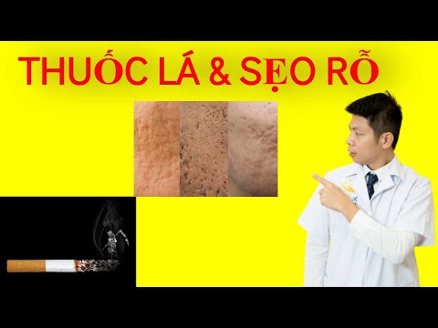 ĐIỀU TRỊ SẸO RỖ(SẸO LÕM)| TREATMENT SCAR|DR.NGỌC