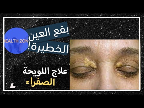 فيديو: من يمكنه إزالة Xanthelasma؟