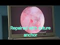 Rotator Cuff Tear - Dr. Arnab Karmakar