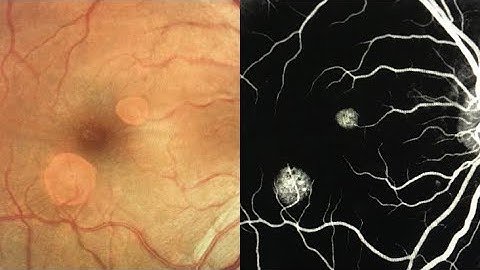 Pigment Epithelial Detachment ( Serous PED ) : Clinical picture / OCT 🥜
