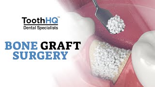 Bone Graft Surgery Procedure - Dr Vadivel , Board Certified Periodontist, Dallas Fort Worth, Texas
