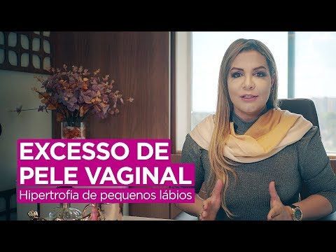 EXCESSO DE PELE VAGINAL (Hipertrofia de pequenos lábios)
