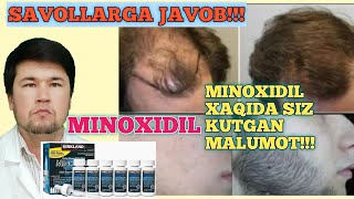 #minoxidil #soch #soqol | MINOXIDIL XAQIDA SIZ KUTGAN VIDEO , SAVOLLARGA JAVOBLAR . TO'LIQ VIDEO !!!