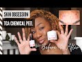 25% TCA CHEMICAL PEEL (Skin Obsession) | Step by step tutorial | before and after results