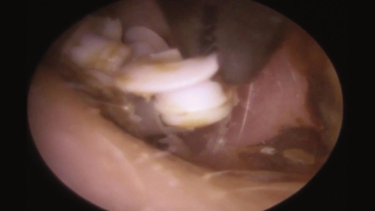 physical education 22 Hearing Aid Filters Found in Man’s Ear?!
