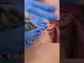 Dr. Emma Completely Transforms Woman With Facial Hair! #badskinclinic #shorts