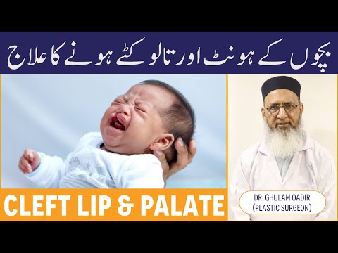 Bachon Ke Hont Aur Talu Kata Hona - Cleft Lip & Palate Treatment & Support - Cleft Lip Ka Ilaj Urdu thumbnail image