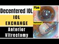 Decentered iol ant vitrectomy secondary lens implantation  principles planning  implementation