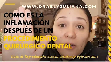 ¿Cuánto tiempo tendré la cara hinchada después de una extracción dental?