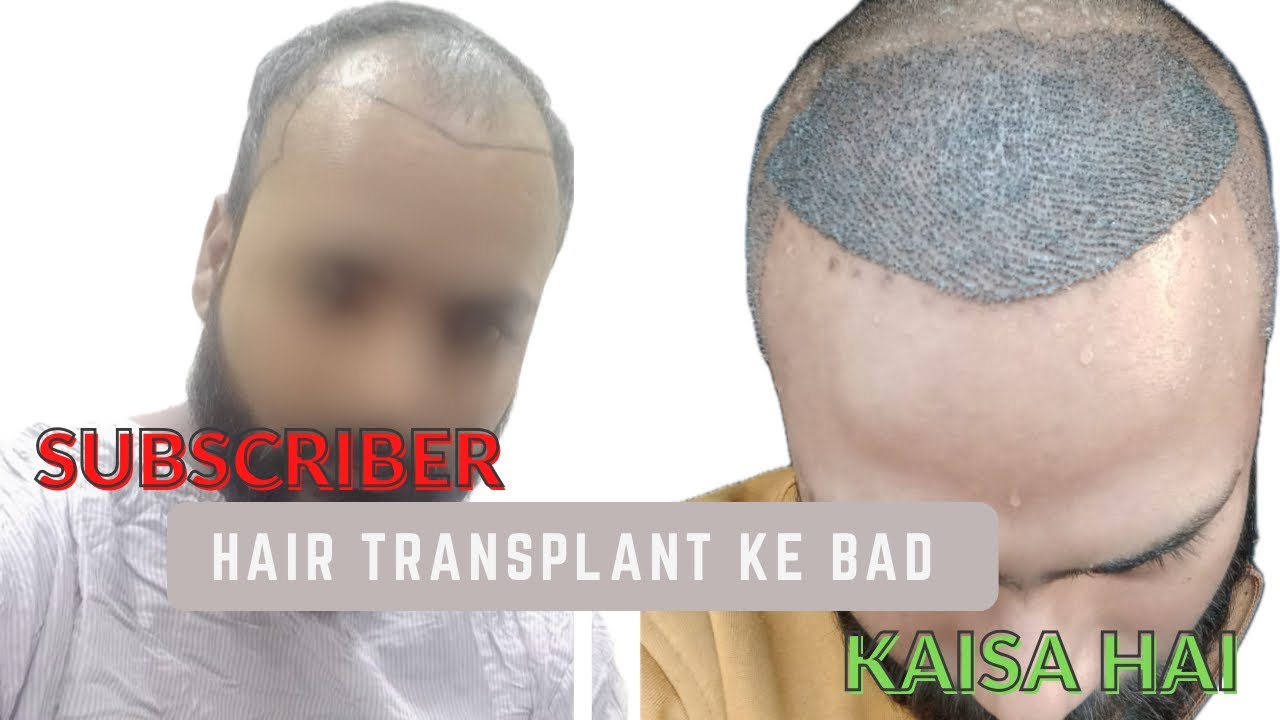 subscriber hair transplant ke bad kaisa hai YouTube