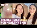 BEST DIET FOR ACNE [NOT what you think...] | How To Get Rid Of Acne &amp; Skin Rashes FOR GOOD