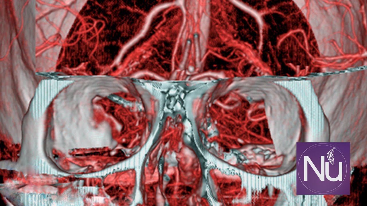 NuTrace Surgical Instrument Tracking- Marking Aesculap Aneurysm Clamps