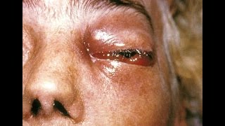 Mucormycosis