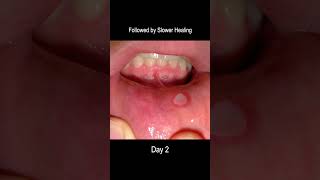 Aphthous Ulcer Time Lapse, From Development to Healing (Cold Sore)