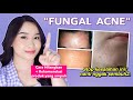 8 Cara Menghilangkan Jerawat Kecil-Kecil di Wajah ("Fungal Acne")