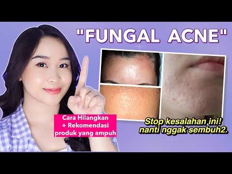 8 Cara Menghilangkan Jerawat Kecil-Kecil di Wajah ("Fungal Acne")