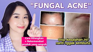 8 Cara Menghilangkan Jerawat Kecil-Kecil di Wajah ('Fungal Acne')