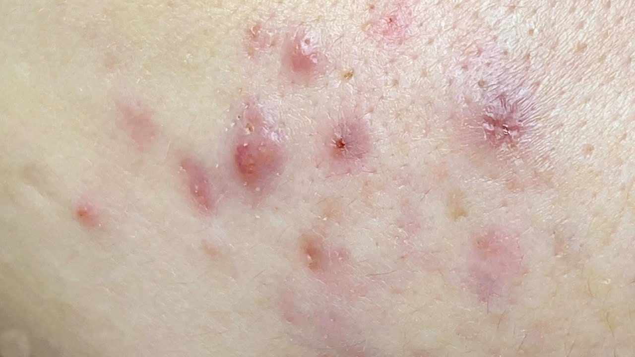 Acne Treament Under The Skin #065