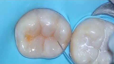 Class I Composite restoration