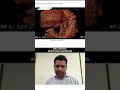 Endometrite Crônica  Sintomas, Consequências e Diagnóstico Essencial