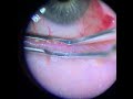 Meibomian Gland Expression (Upper and Lower Lid)