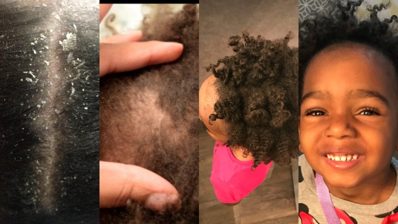 1 Month Update On Toddlers Eczema Natural Hair Youtube