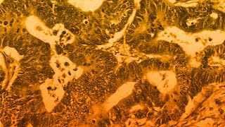 Tatme Para Eliminar Cánceres En Pacientes Con Cáncer De Recto