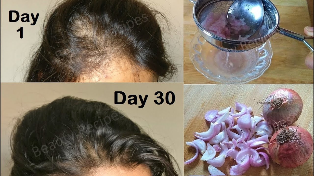 Regrow Lost Hair from Roots with Onion juice & Coconut Hair Oil - Double  hair growth & get Long hair - YouTube