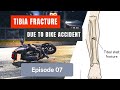 Tibia and Fibula fractured Ep. 07: 3rd Doctor checkup & improvement.