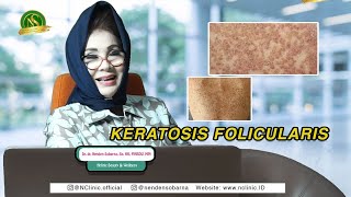 Things You MUST Know About Keratosis Follicularis!