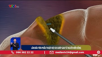 Bác sỹ Việt Nam lần đầu nội soi lấy mảnh ghép gan từ người hiến sống | VTV24
