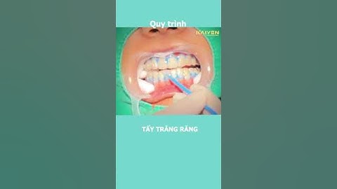 Quy trình Tẩy trắng răng - Nha Khoa Quốc Tế KAIYEN