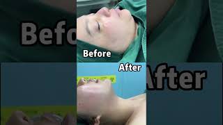 #Beauty #Face #Jawline Makes the entire facial contour more natural.