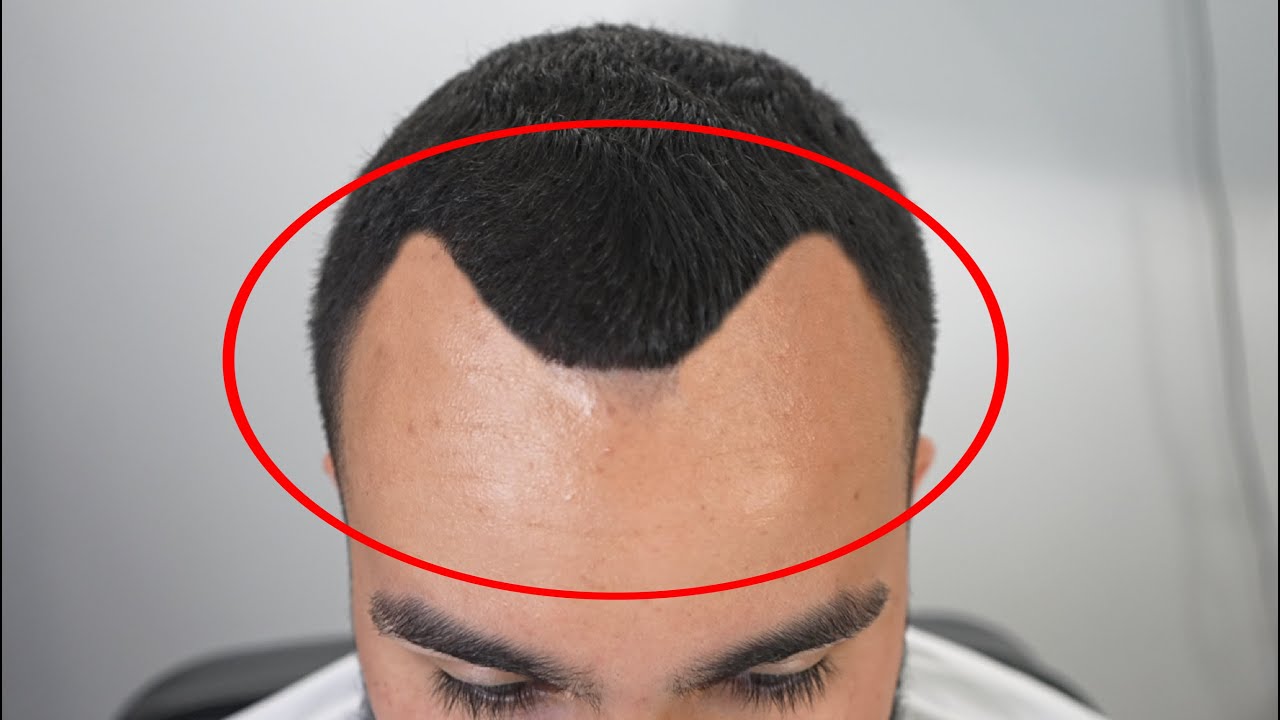 He Begged Me To Fix His VEGETA HAIRLINE YouTube He Begged Me To Fix His VEGETA HAIRLINE YouTube